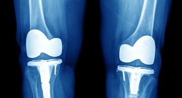 Systematic Joint Replacement Surgery